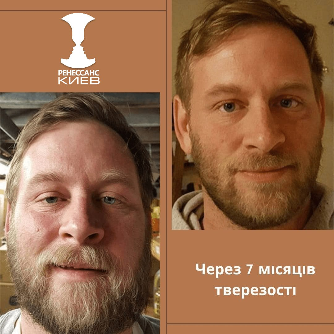 Особиста історія: фото до та через 7 місяців тверезості